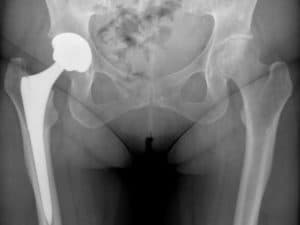 Hip replacement X-ray